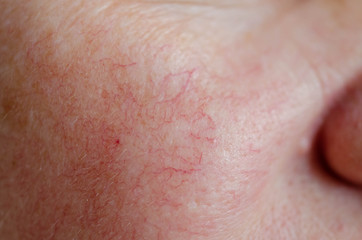 Close up of human face skin with vascular problems