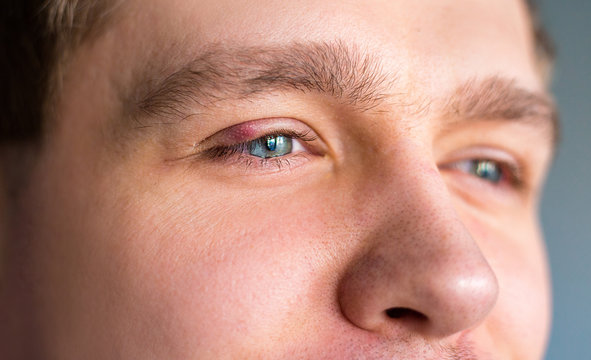 Red upper eye lid with onset of stye infection due to clogged oil gland and staphylococcal bacteria.