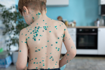 Chicken pox rash view from the back