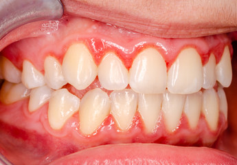 teeth with gingivitis - obrazy, fototapety, plakaty