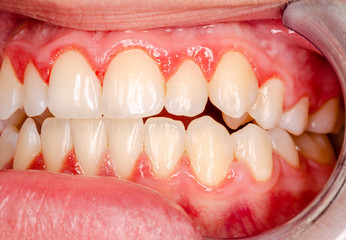 teeth with gingivitis