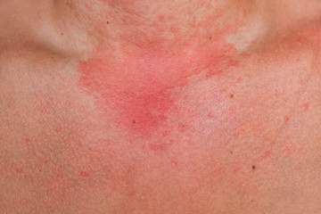 Fototapeta premium Allergic skin reaction on the man neck and face - red rash