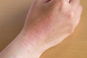 手の皮膚にできた湿疹