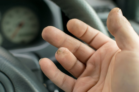 Hand Of A Man With A Missing Finger Phalanx On The Background Of The Steering Wheel And Dashboard Of The Car