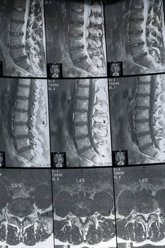 MRI scan of sacro lumbar spines of a patient. the Magnetic Resonance Imaging shows degenerative changes of L spines, lumbar discs herniation and nerve roots compression