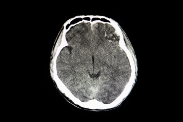 CT brain scan of a patient with bilateral hemorrhagic contusion