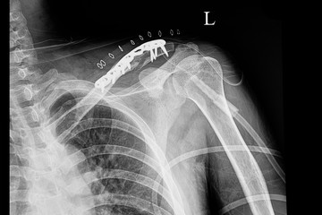 A shouder film xray of a patient with fractured clavicle - obrazy, fototapety, plakaty
