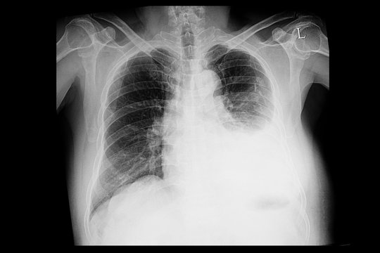 A chest xray of a patient with left pleural effusion