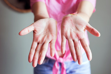 Naklejka premium Hands woman with rash or papule and scratchon palm on from allergies,Health allergy skin care problem