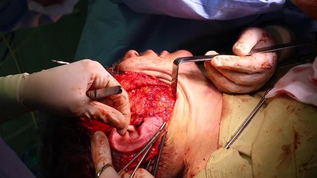 Plastic surgery to lift the face. A team of surgeons performed a facelift surgery. Close-up, blue light.