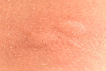 Fototapeta premium Swollen skin after a mosquito bite. Blisters appeared at the site of the mosquito bite. Close up macro