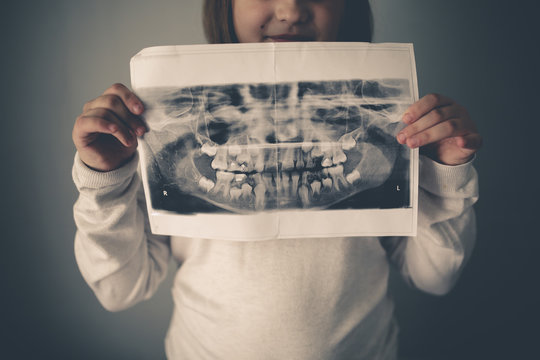 X-ray Of Calf's And Permanent Teeth In Hands Child