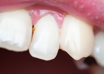 Closeup of dental plaque on man's teeth caused by coffee residual