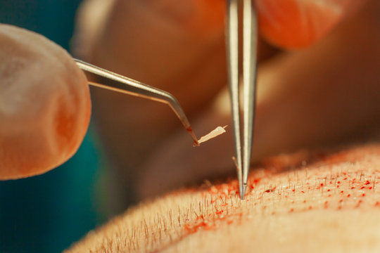 Macrophotography of a hair bulb transplanted into a hairless area. Baldness treatment. Hair transplant. Surgeons in the operating room carry out hair transplant surgery. Surgical technique that moves