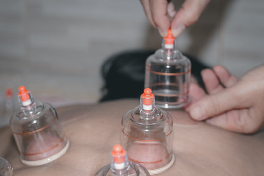 A person receiving chinese medicine treatment with suction cups, Cupping Treatment On Back