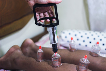 Young man receiving chinese medicine treatment with suction cups, Acupuncture therapist placing cup...