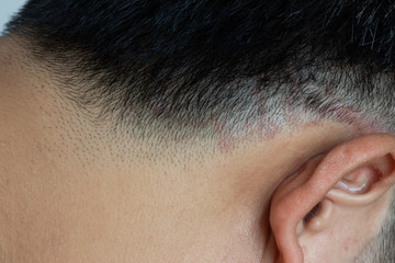 Closed up of ringworm (tinea) on head of asian man (Dermatitis)