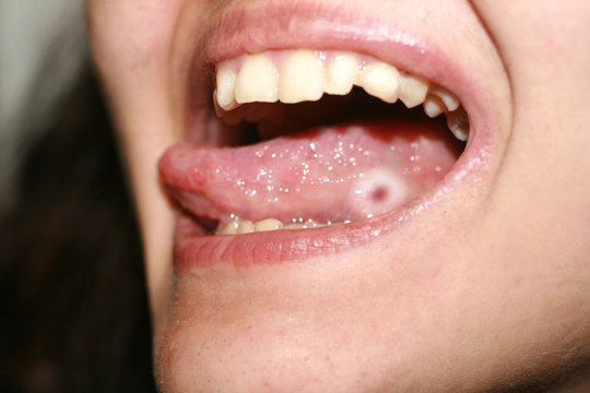 Amphotoid stomatitis. Candidiasis of the tongue. Ulcer on the tongue. Candida fungus.
