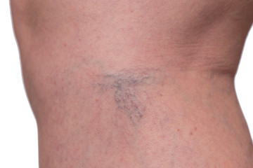 varicose veins and spider veins, female legs close-up on a white background