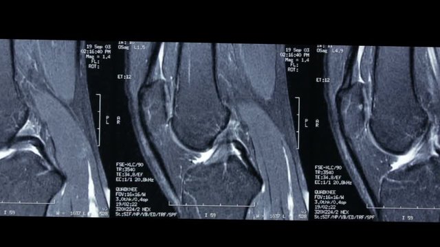 Zoom-in video of R.M.N. Nuclear magnetic resonance, of human knees, with cross-section and sagittal section.