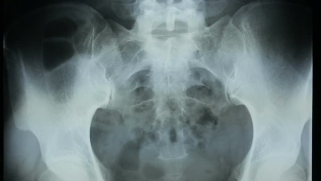 Zoom out on the radiograph details of pelvic bones and human spine.