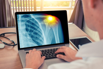 Doctor watching a laptop with x-ray of a chest with pain in the shoulder. Radiology concept