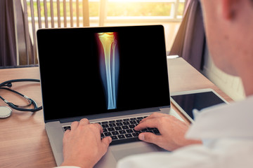 Doctor watching a laptop with x-ray of leg with pain in the knee. Radiology concept