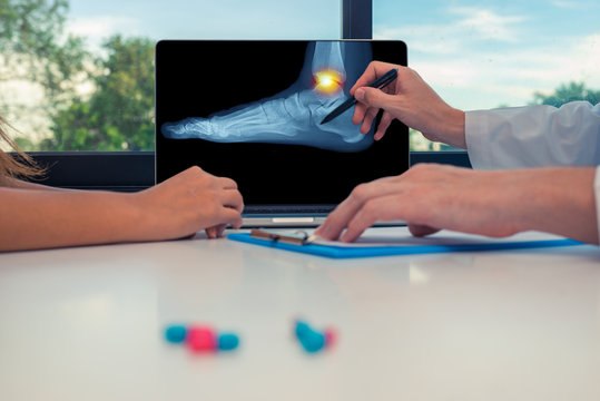 Doctor showing a x-ray of a foot with pain on the ankle on a laptop to a woman patient. Pills on the desk