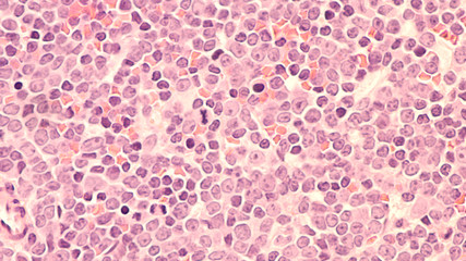A staging bone marrow biopsy shows replacement of normal elements by diffuse large B-cell lymphoma,...