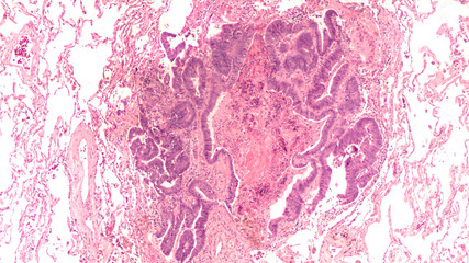Micrograph of colonic adenocarcinoma, metastatic to lung.  Normal lung tissue can be seen...