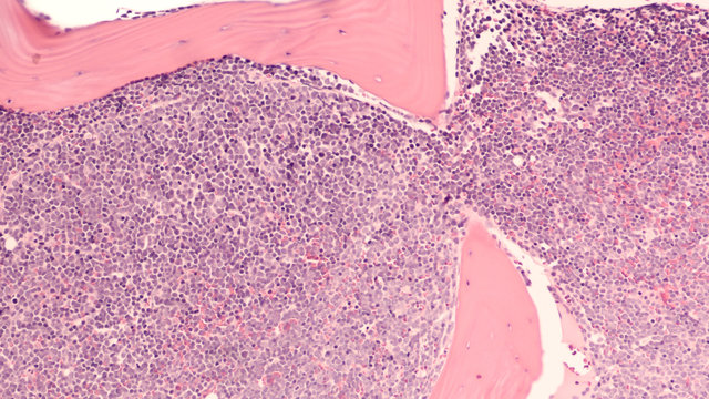 A staging bone marrow biopsy shows replacement of normal elements by diffuse large B-cell lymphoma, a type of non Hodgkin lymphoma, a malignancy (cancer) of lymphocytes, in this case spread to bone. 
