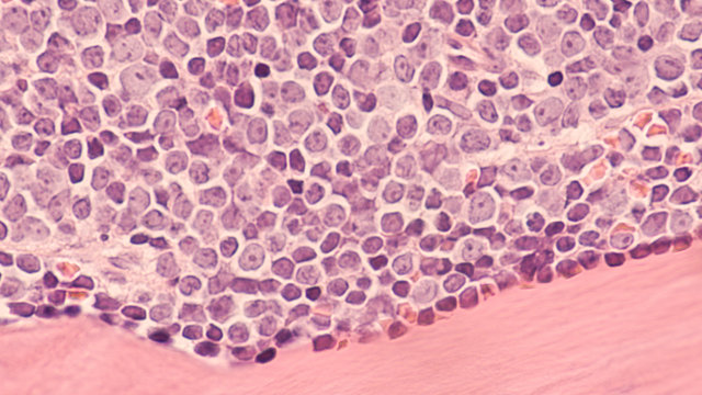 A Staging Bone Marrow Biopsy Shows Replacement Of Normal Elements By Diffuse Large B-cell Lymphoma, A Type Of Non Hodgkin Lymphoma, A Malignancy (cancer) Of Lymphocytes, In This Case Spread To Bone. 