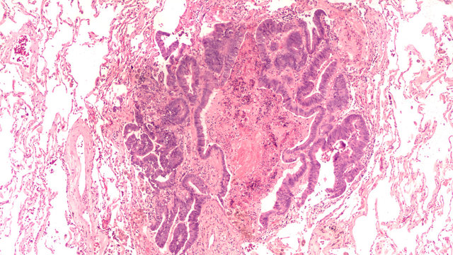 Micrograph of colonic adenocarcinoma, metastatic to lung.  Normal lung tissue can be seen surrounding the tumor deposit in this patient with a prior history of colon cancer.  