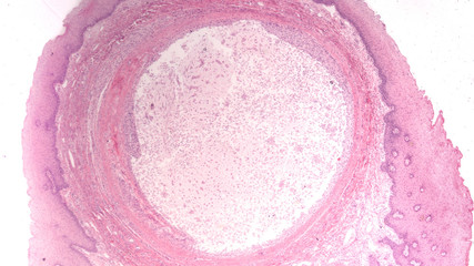 Microscopic image of a mucocele (mucus cyst), a fluid-filled swelling that occurs on the lip or the mouth which develops when accessory salivary glands become plugged with mucus.  