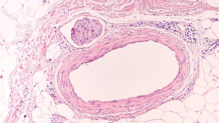 Photomicrograph showing vascular  (lymphovascular) invasion of breast cancer (carcinoma) with a...