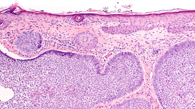 Skin biopsy pathology of basal cell carcinoma, the most most common type of sun induced skin cancer, invading the dermis.  Basaloid cells with nuclear palisading and clefting are characteristic.