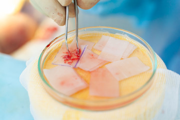 Hair follicles in the Cup close-up. Baldness treatment. Hair transplant. Surgeons in the operating room carry out hair transplant surgery. Surgical technique that moves hair follicles from a part of