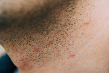 Bristles on the guy's face and neck. Red pimples on the skin. Irritation on the skin from shaving.