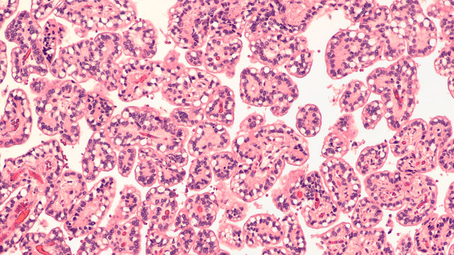 Photomicrograph (microscopic photograph) showing histology of a choroid plexus papilloma, a rare type of benign brain tumor.  This example has prominent cytoplasmic vacuoles. 