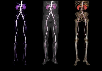 Comparison of CTA femoral artery run off  3D rendering image  of femoral artery with kidney for...
