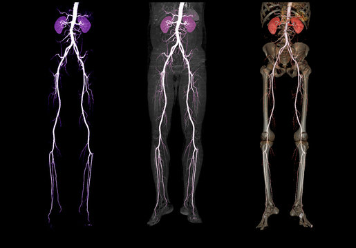 Comparison of CTA femoral artery run off  3D rendering image  of femoral artery with kidney for Patients Presenting with Acute or Chronic Peripheral Arterial Disease.