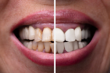 Woman Teeth Before And After Dental Treatment