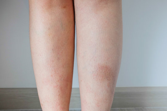 Dermatitis on the both of  women leg that apparent clearly after take a bath