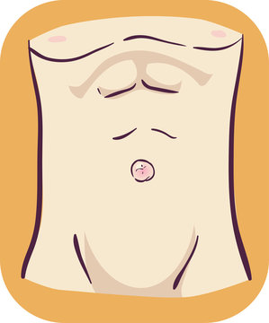 Symptom Umbilical Hernia Illustration