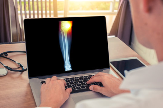 Doctor watching a x-ray of leg with pain in the internal knee. Radiology concept