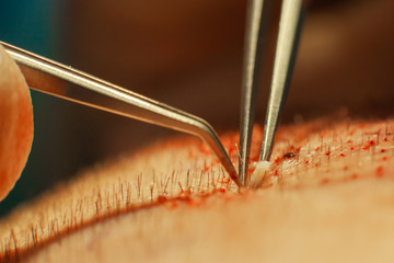 Macrophotography of a hair bulb transplanted into a hairless area. Baldness treatment. Hair transplant. Surgeons in the operating room carry out hair transplant surgery. Surgical technique that moves - obrazy, fototapety, plakaty