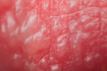 Beginning of growing herpes on caucasian male man on front upper lip super macro microscope