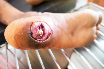 closeup infection wound in the foot of patients .	