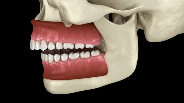 Overbite dental occlusion ( Malocclusion of teeth ). Medically accurate tooth 3D animation