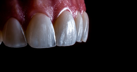 full arch ceramic veneers